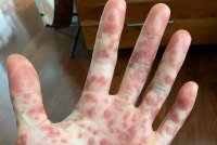 The palm of a hand and fingers is covered in red spots.