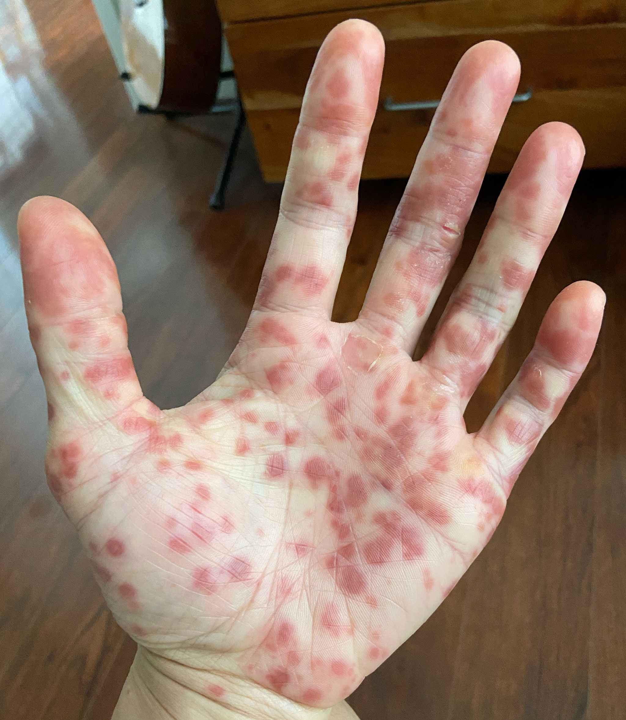 I Was Diagnosed With Monkeypox and the Symptoms Are Pretty Brutal