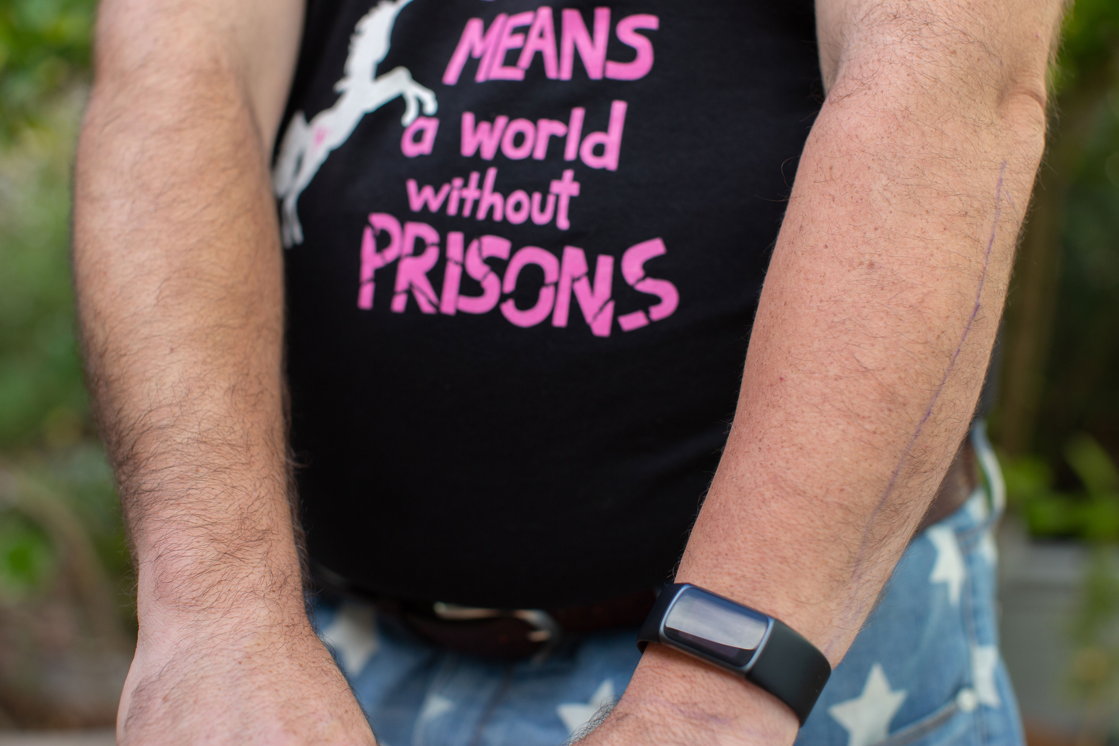 A close-up of a man's forearms where his left arm is marked with a line and has less hair than his right arm. 