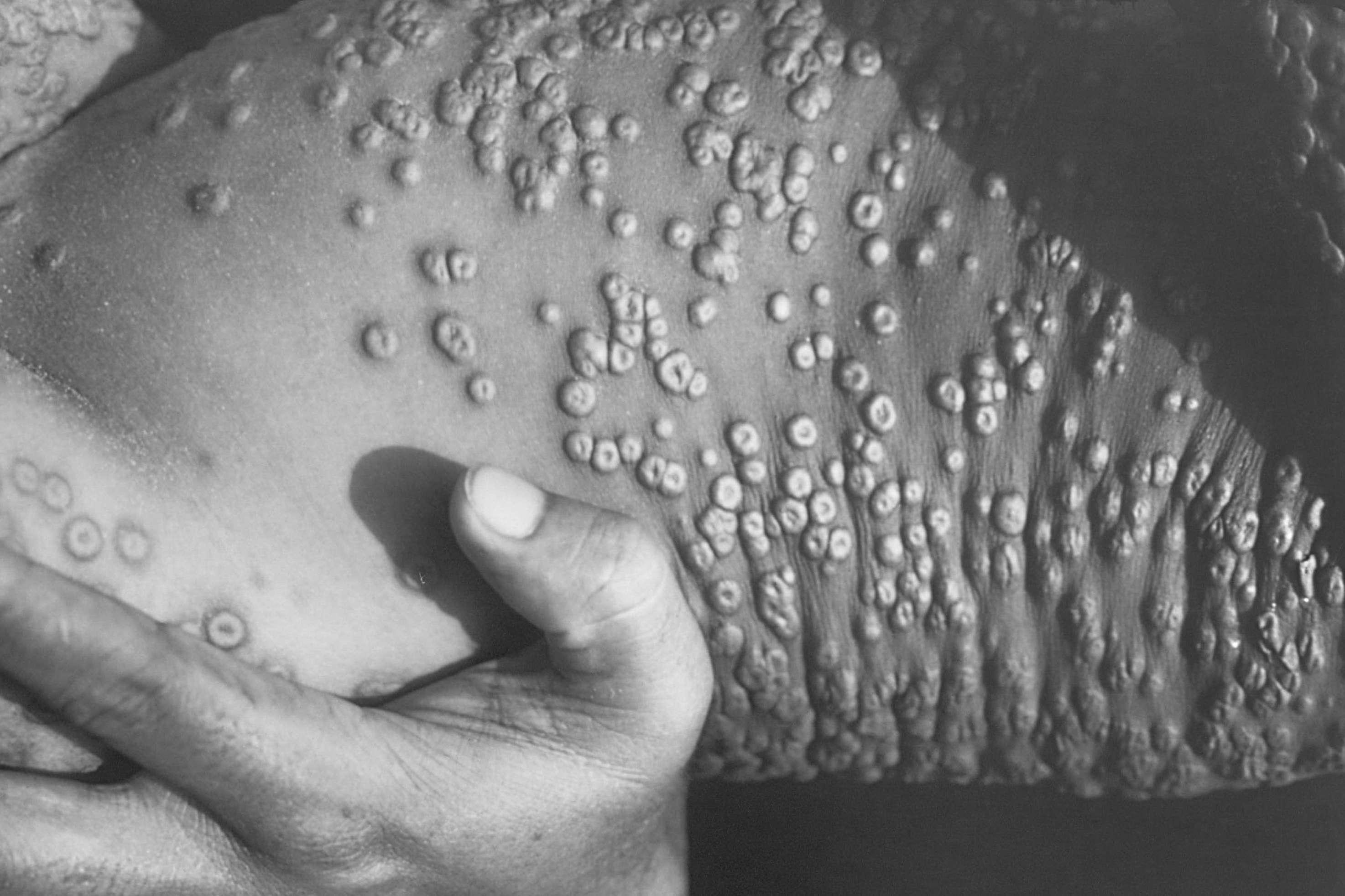 A black and white photograph shows the side of a person's body who is covered in smallpox pustules.