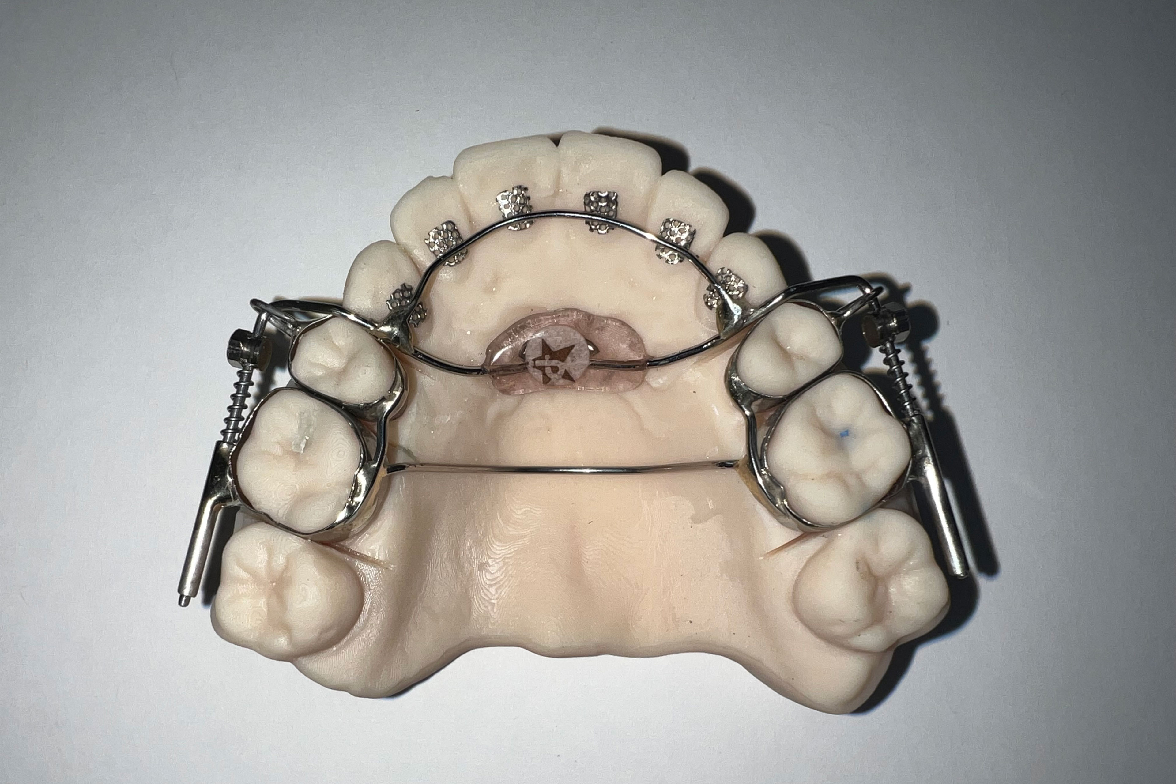 A image of the AGGA device on a model of a lower jaw.