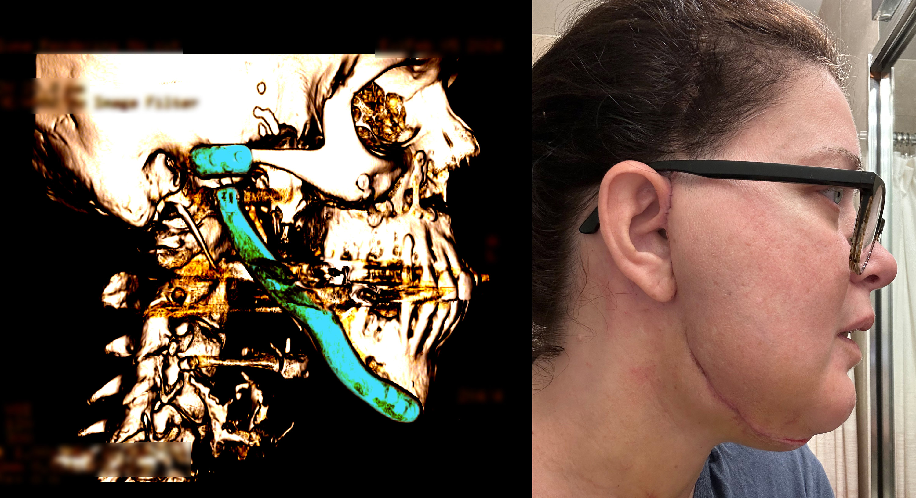 Two images shown next to each other. The left is a scan of a skull in profile with a total jaw replacement implant highlighted. The right is a photo of a woman's face in profile showing a scar along the side of her face.