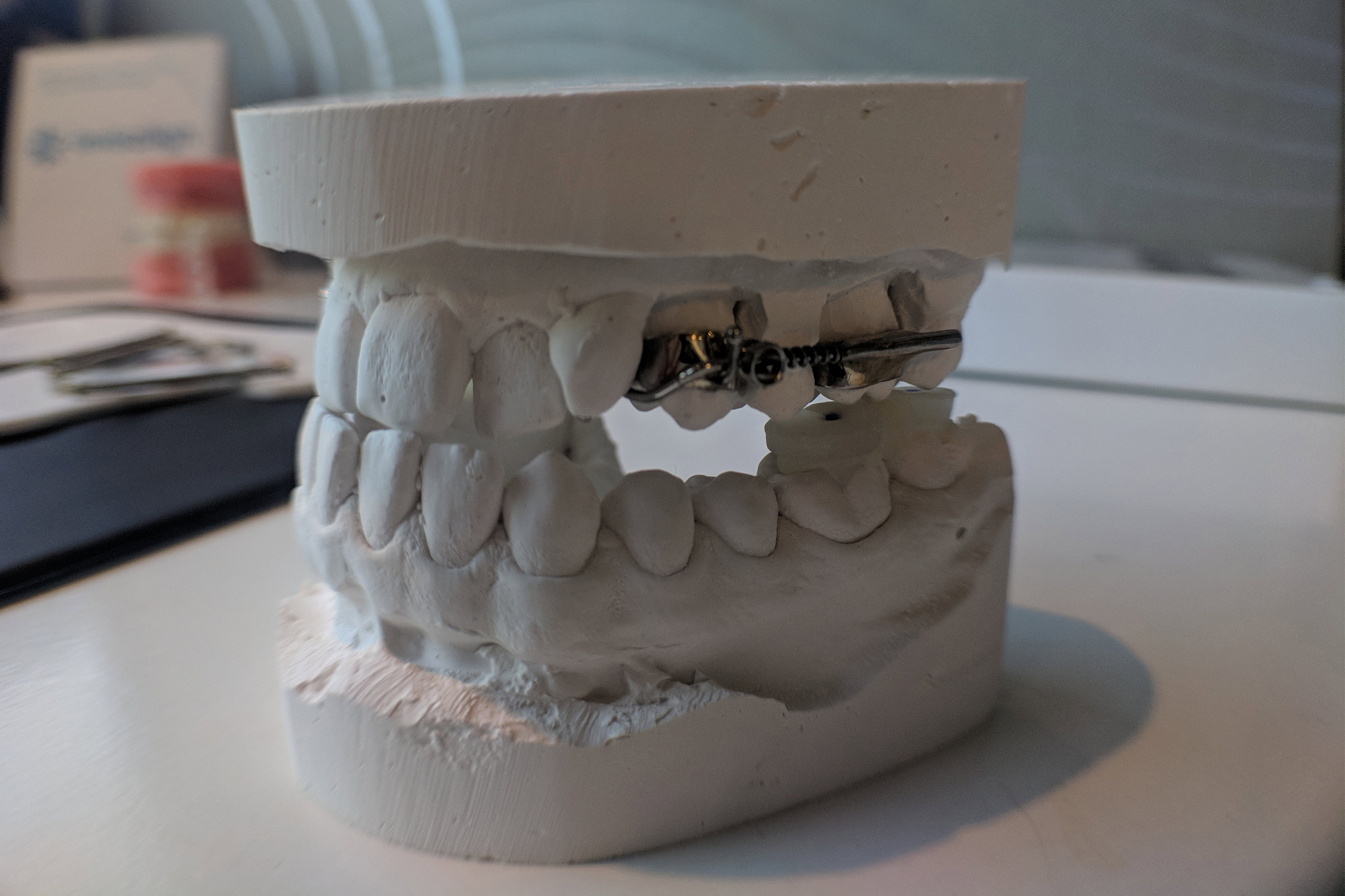 A photo of an AGGA device attached to a cast of a patient's mouth.