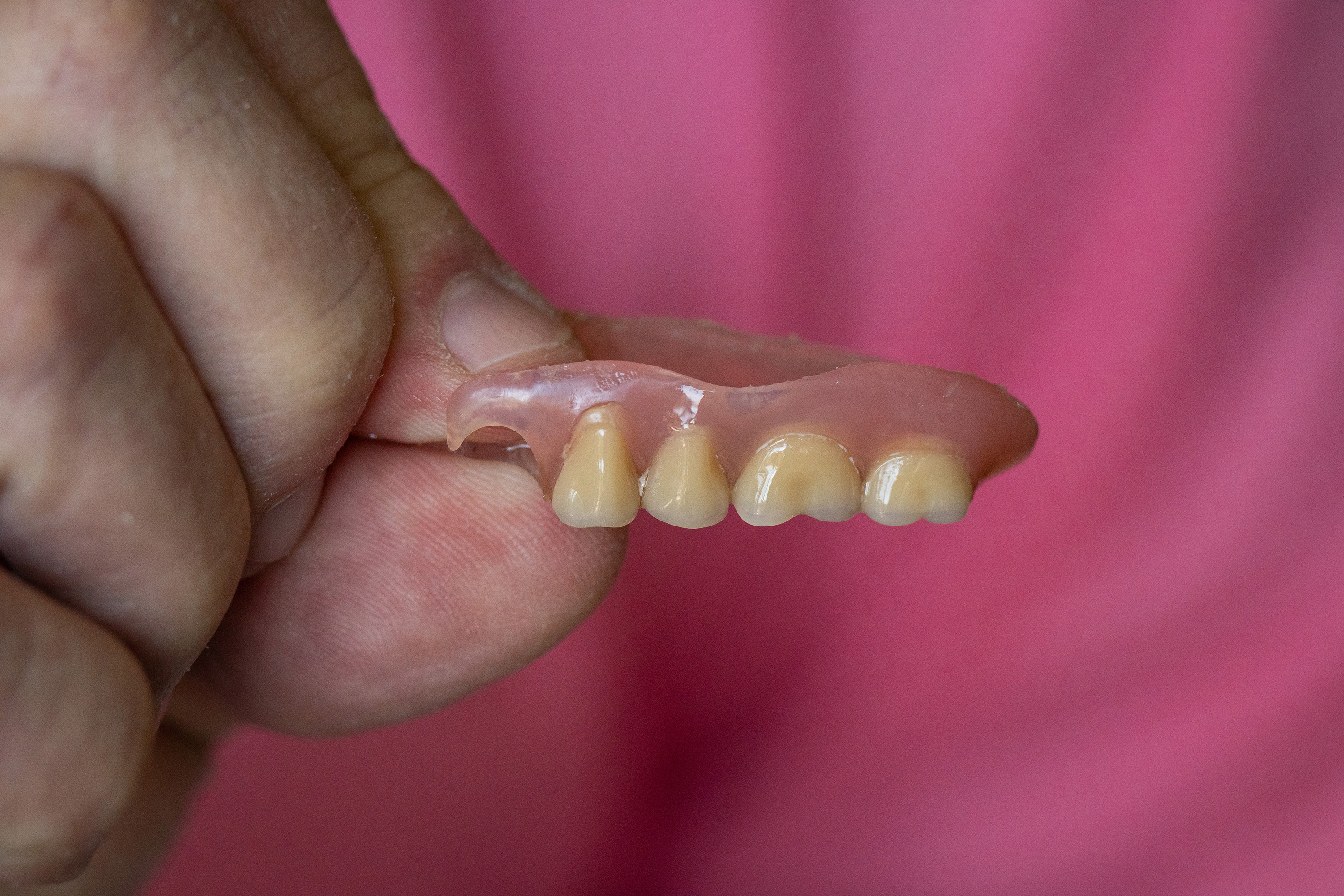 A photo of a hand holding up a partial denture.