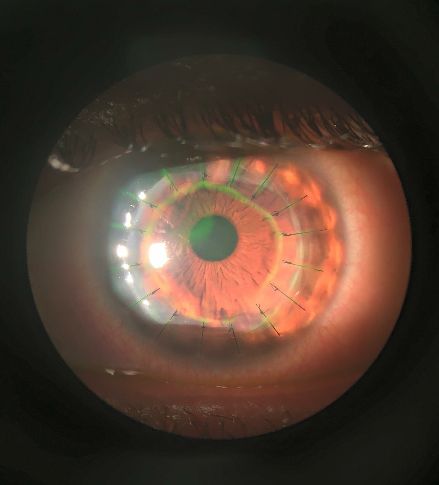 A magnified photo of an eye with corneal transplant.